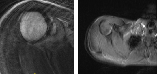MRI-3T Right Shoulder Non-contrast