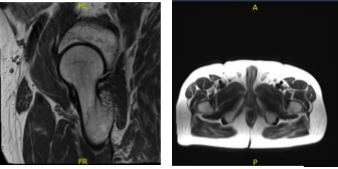 MRI-3T Right hip non-contrast