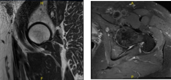 MRI-3T left hip non-contrast