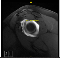 MRI-3T Arthrogram Left Shoulder