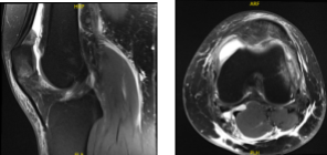 MRI Left Knee non-contrast