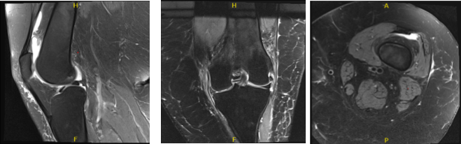 MRI Left Knee non-contrast