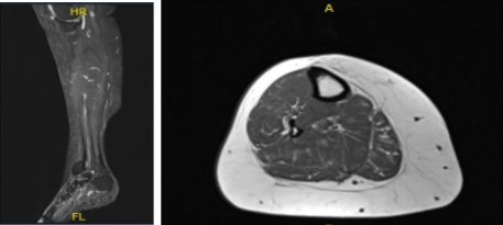MRI- Right Calf Non-contrast