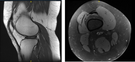 MRI Right Knee Non-contrast