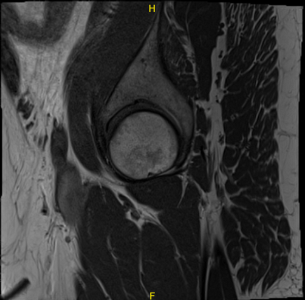 MRI Right hip non-contrast