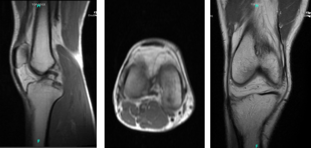 MRI Right knee non-contrast