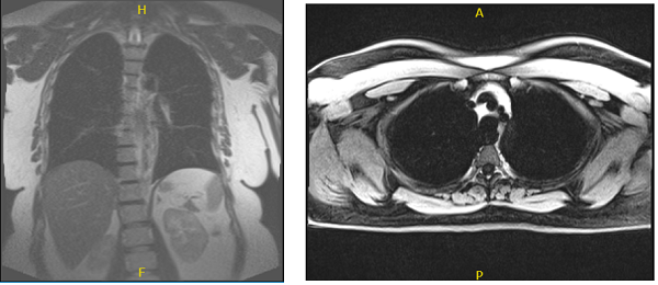 MRI chest without and with contrast