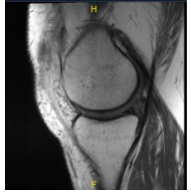 MRI presented to post operative visit, no visibility of the cyst