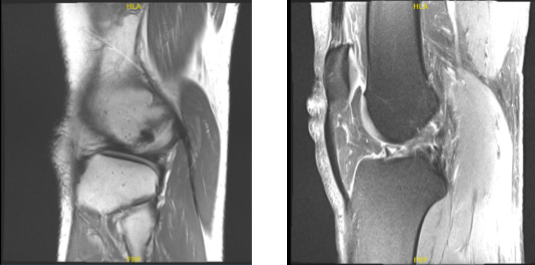 MRI right knee non-contrast