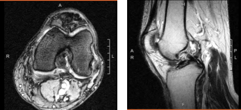 Magnetic resonance imaging of the left knee