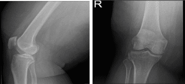 Right Knee X-ray AP Lateral and Oblique
