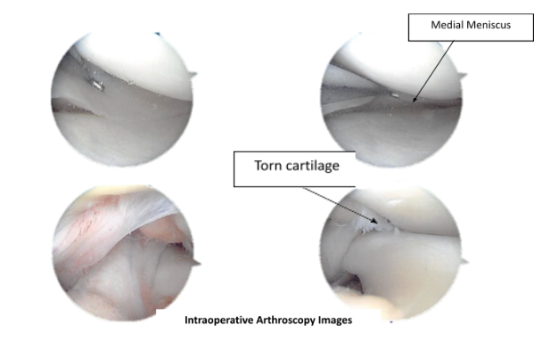 Intraoperative Arthroscopy images
