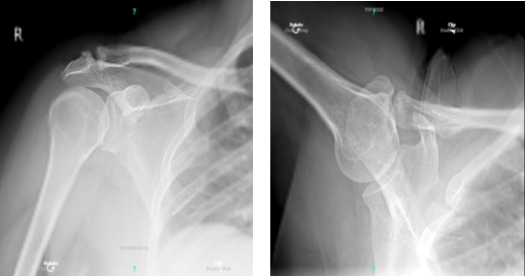 X-ray bilateral shoulders