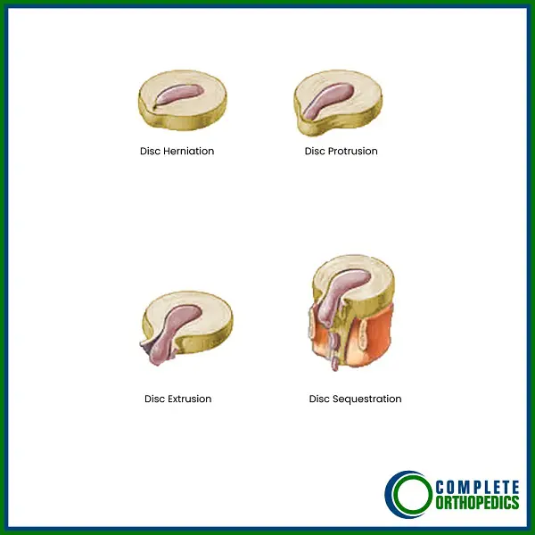 Disc Rupture Classification Illustrated