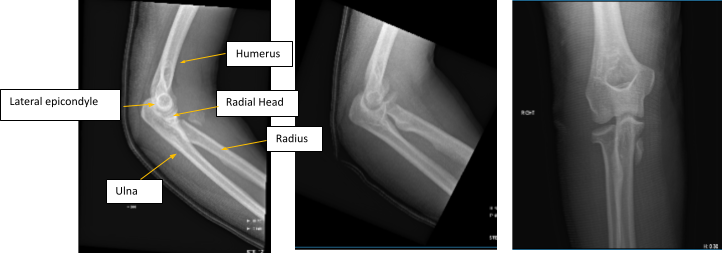 Figure 1. AP Oblique and Flexion Lateral Projection of Right Elbow