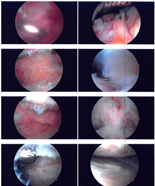 Intraoperative photo