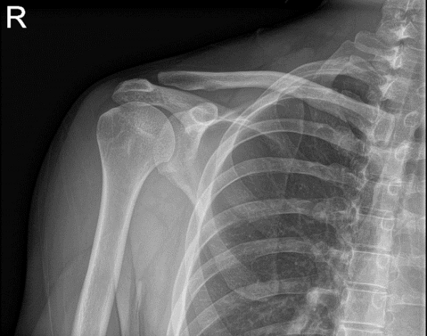 Bilateral Shoulder X-ray AP External and AP Internal