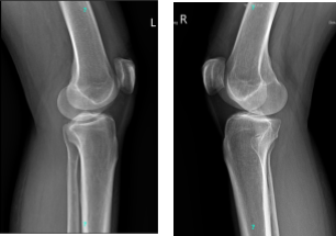 X-ray Bilateral Knees 3 views each