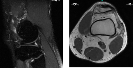 MRI Left Knee Non-contrast
