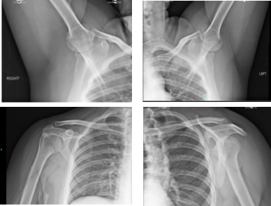 X-ray Bilateral Shoulders