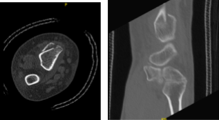 CT Right wrist non-contrast