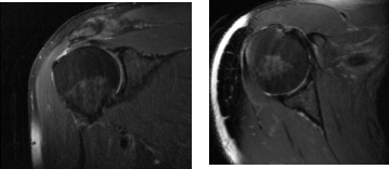 MRI Right Shoulder Non-contrast