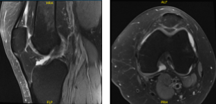MRI-3 Left knee non-contrast