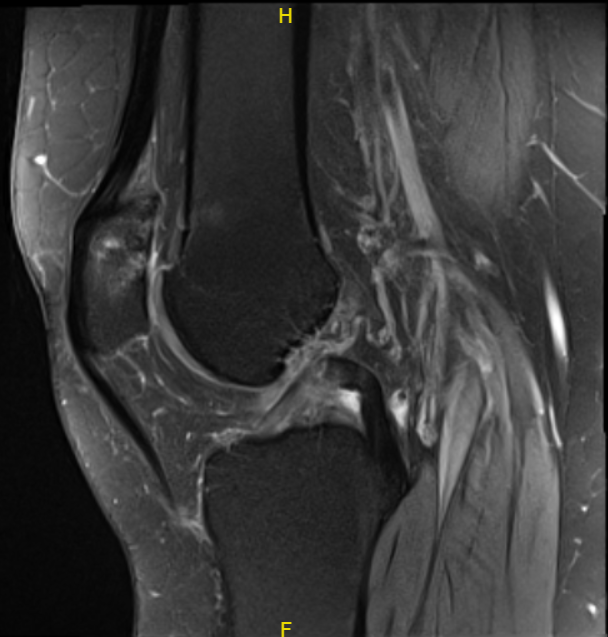 MRI-3T Left knee non-contrast