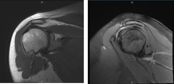 MRI-3T Left Shoulder non-contrast