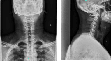 X-ray cervical spine 2 or 3 views