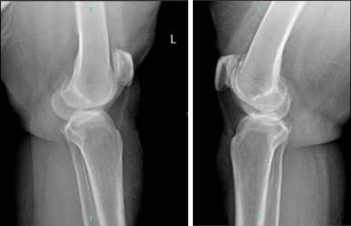 Left and right knee x-ray complete patella