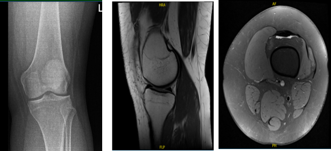 MRI of the left knee