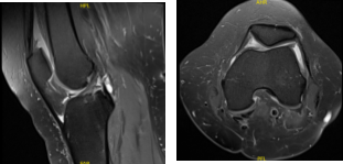 MRI Left knee non-contrast