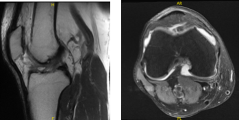 MRI-3T Right knee non-contrast