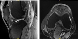MRI-3T Left Knee non-contrast