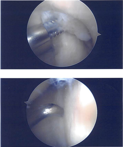 Intraoperative images