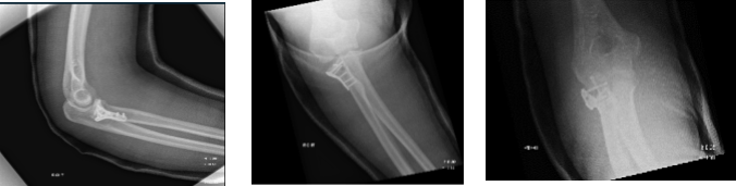 Figure 2. Image of Elbow with 3 cortical screws
