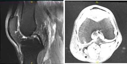 MRI-3T Left knee non-contrast