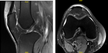 MRI-3t Right Knee non-contrast
