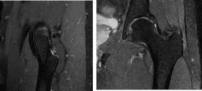 MRI Left Hip non-contrast