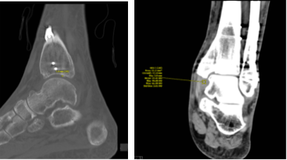 CT-Left ankle non-contrast