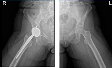 Hip Bilateral with pelvis 3 or 4 more view