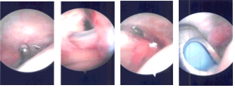 Intraoperative Arthroscopic Images