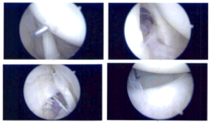 Intraoperative Arthroscopic Images