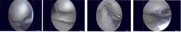 Intraoperative Arthroscopic Images