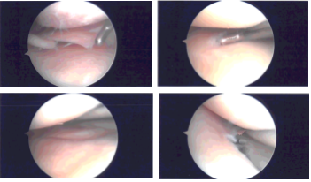 Intraoperative Arthroscopy Images