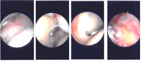 Intraoperative Arthroscopy Images