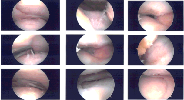 Intraoperative images