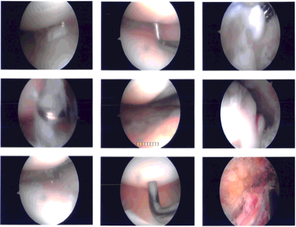 Intraoperative photo