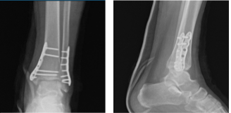 Left Ankle X-ray complete 3 or more views 1 week post operative